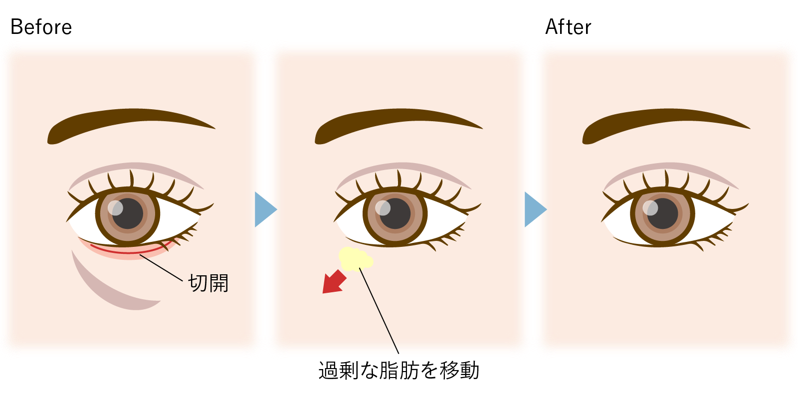 裏ハムラ法（経結膜）