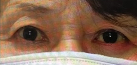 眼瞼下垂の術後